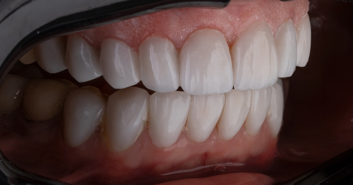 The Role of Tongue Posture in Oral Health